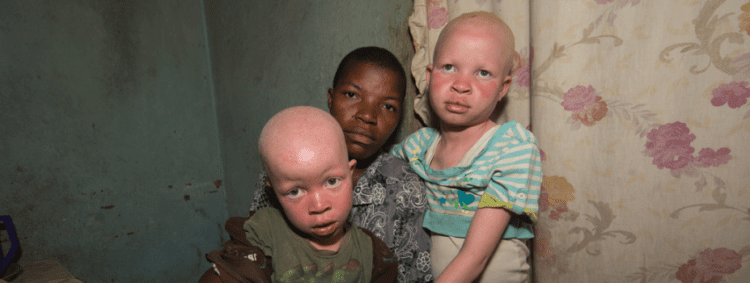 Malawi: Killing of a girl with albinism shows community urgently needs better protection